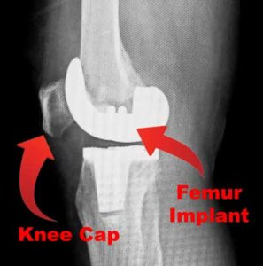 X-Ray Image Of Total Knee Replacement