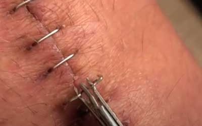 Does It Hurt To Have Staples Removed After Knee Replacement Surgery