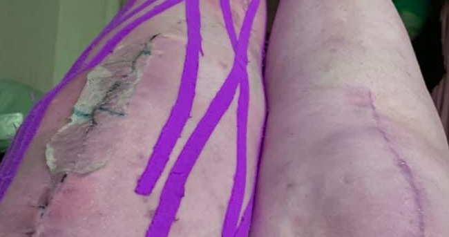 Kinesiology Tape After Knee Replacement