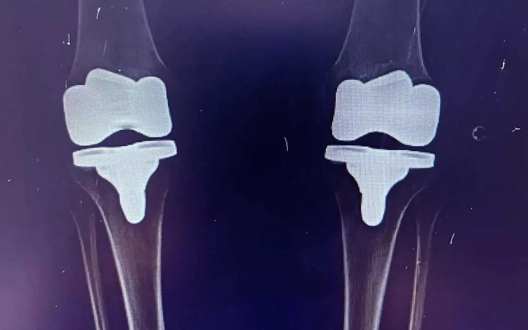 3 Pros & Cons of Bilateral Knee Replacement