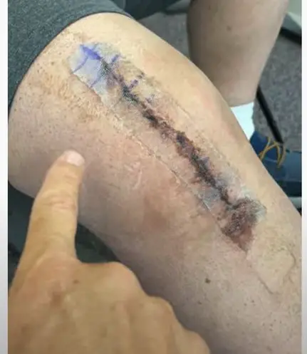 Post surgical incision for total knee replacement