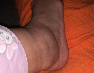 Ankle Pumps for Swelling