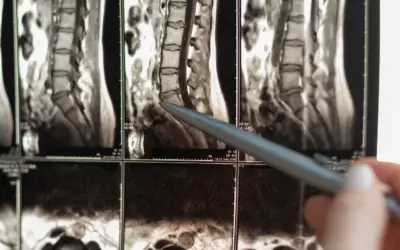 Overview of Spinal Stenosis