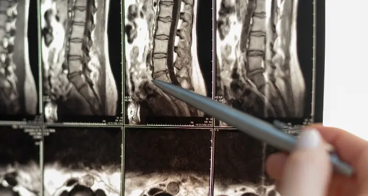 Overview of Spinal Stenosis